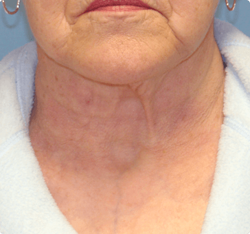 Facial Rejuvenation Clifton Park, NY - Celine Aesthetic Medicine